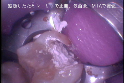 進行した虫歯に対する歯科用レーザーを使用した当院の症例