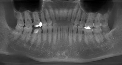 進行した虫歯に対する歯科用レーザーを使用した当院の症例②