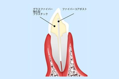 ファイバーコア