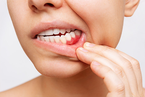 歯周病の進行度に合わせた治療方法