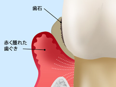 中等度歯周病の症状と治療法