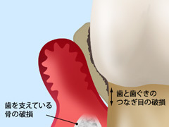 重度歯周病の症状と治療法