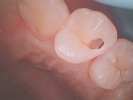 削る量を最小限に抑えた当クリニックの虫歯治療