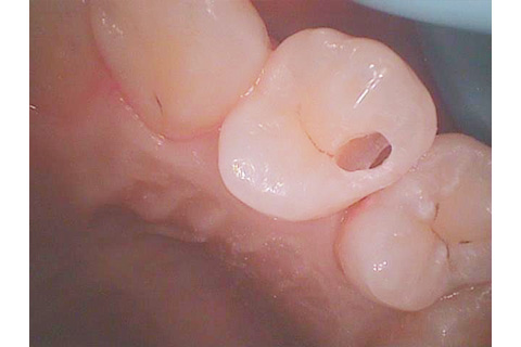 削る量を最小限に抑えた当クリニックの虫歯治療