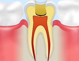 【虫歯の除去】